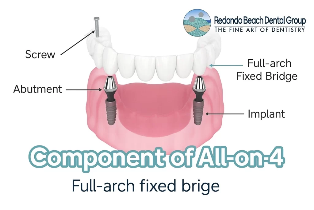 all on 4 dental implants