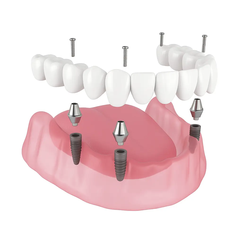 all on 4 implants